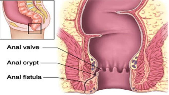 Ayurvedic Treatment for Fistula in Kochi, Kerala - Parathuvayalil Ayurveda Hospital