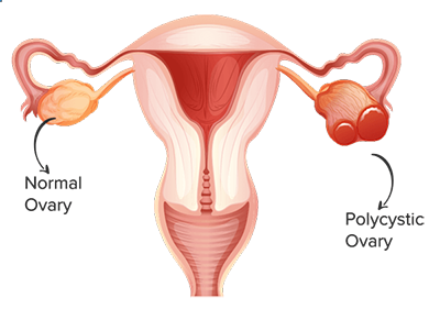 Ovary - Best PCOD/PCOS/Infertility Treatment in Kochi, Kerala - Parathuvayalil Ayurveda Hospital